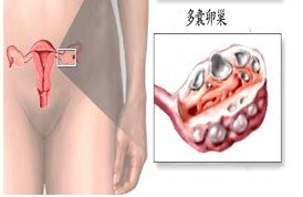 女性多囊卵巢的检查要怎么做才彻底呢