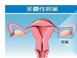 多囊卵巢综合症给女性带来伤害有多大呢
