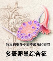 女性患了多囊卵巢需要注意哪些呢