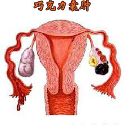 女性患卵巢巧克力囊肿到底严重吗