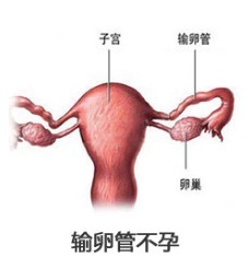 输卵管不通