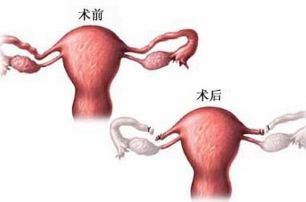 输卵管不通术后图
